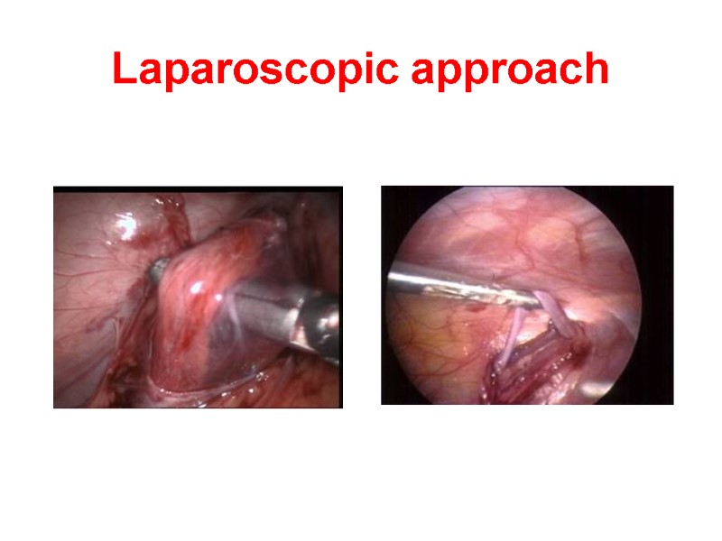 Laparoscopic approach